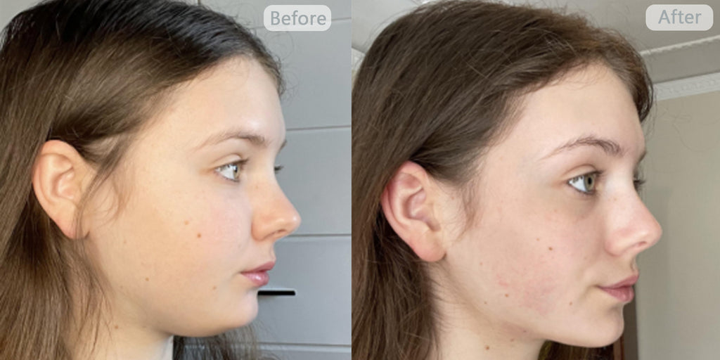 V-Line Face Lifting Band (Lift)